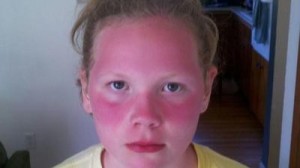 bad-sunburn